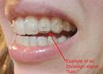 Why Do Aligners Get Loose?