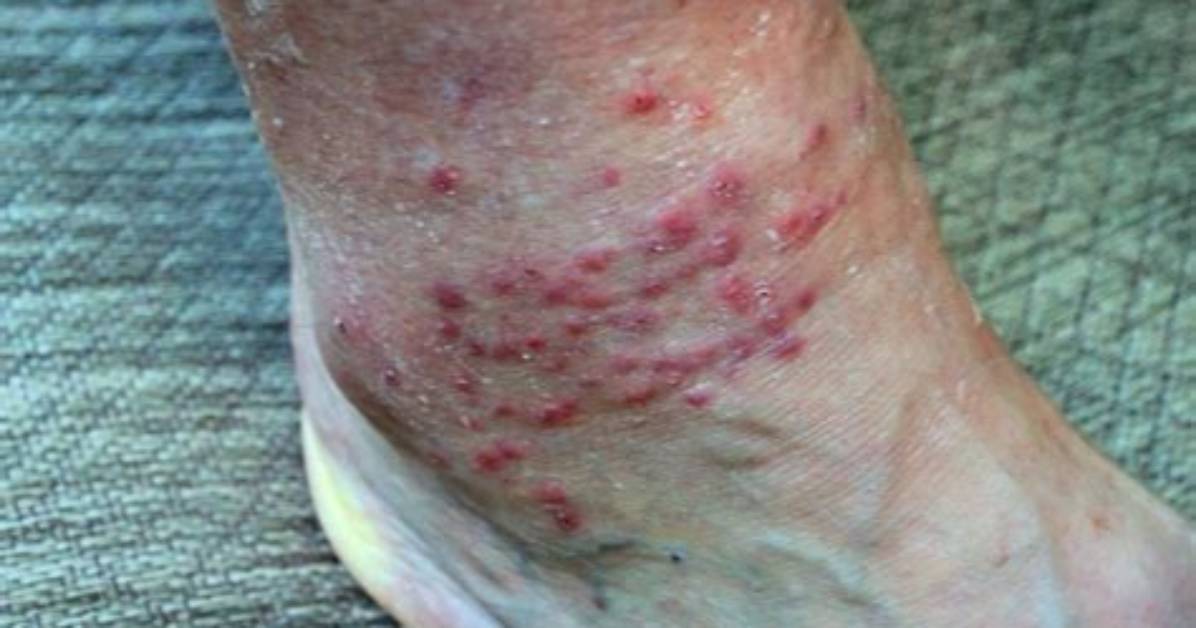 Why Do Chigger Bites Ooze?