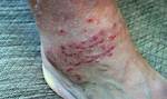 Why Do Chigger Bites Ooze?