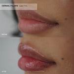 Why Do Fillers Go Lumpy?