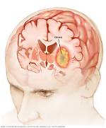 Why Do Gliomas Form?