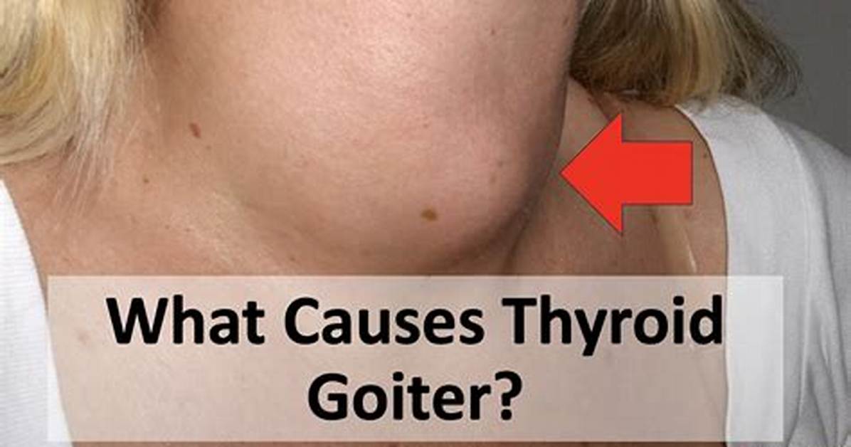 Why Do Goiter Grow?