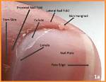 Why Do Hangnails Form?