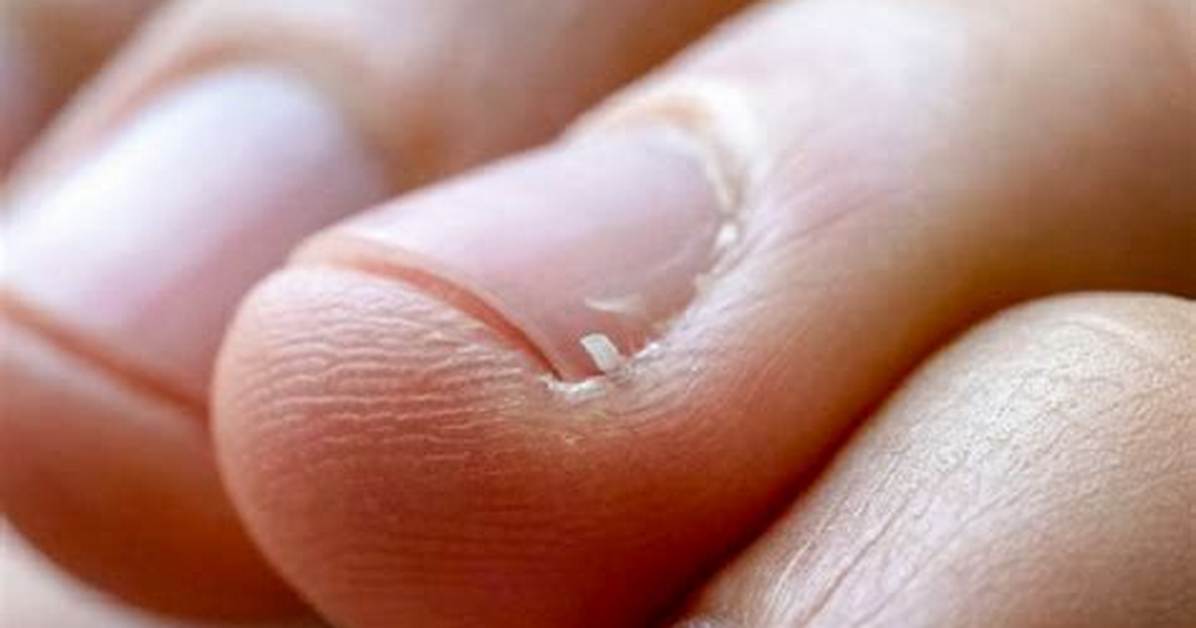 Why Do Hangnails Hurt