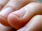 Why Do Hangnails Hurt