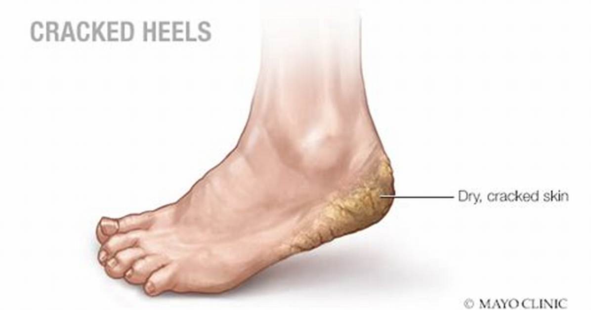 Why Do Heels Crack?