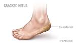 Why Do Heels Crack?