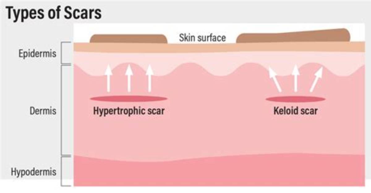 Why Do Hypertrophic Scars Form?