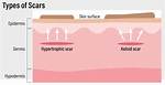 Why Do Hypertrophic Scars Form?
