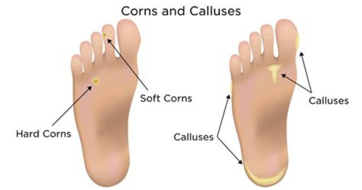 Why Do I Get Calluses?