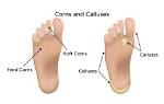 Why Do I Get Calluses?