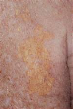 Why Do I Have a Yellow Patch on My Skin?