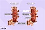 Why Do I Keep Getting Diverticulitis?