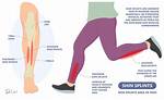 Why Do I Keep Getting Shin Splints When I Walk?