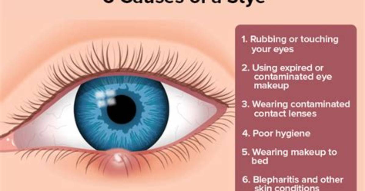 Why Do I Keep Getting Styes?