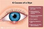 Why Do I Keep Getting Styes?