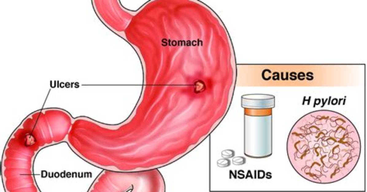 Why Do Peptic Ulcers Bleed?