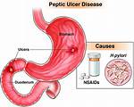 Why Do Peptic Ulcers Bleed?