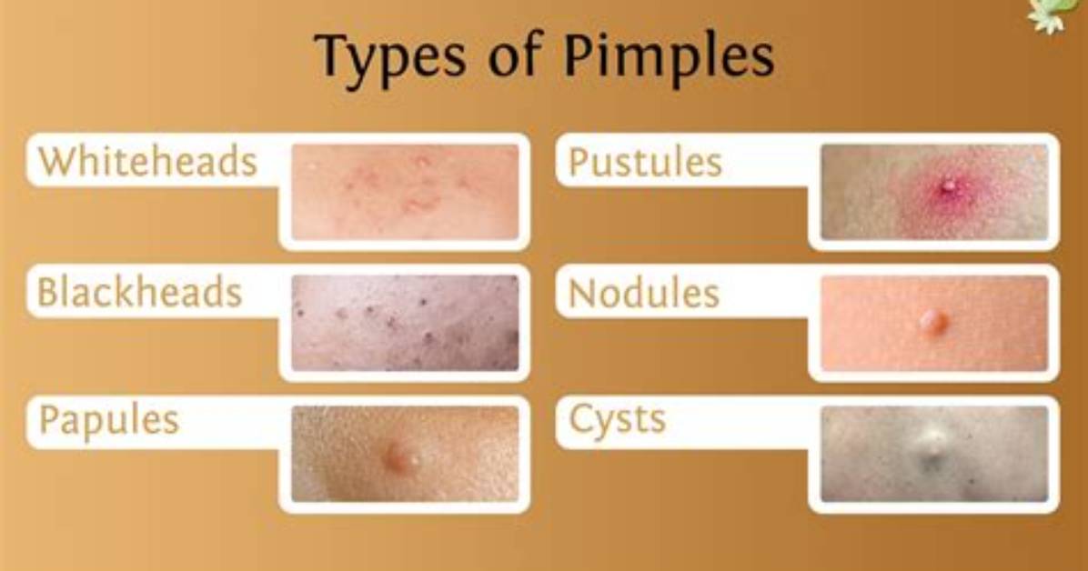 Why Do Pimples Form?