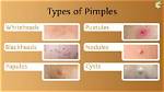 Why Do Pimples Form?