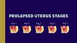 Why Do Prolapses Happen?
