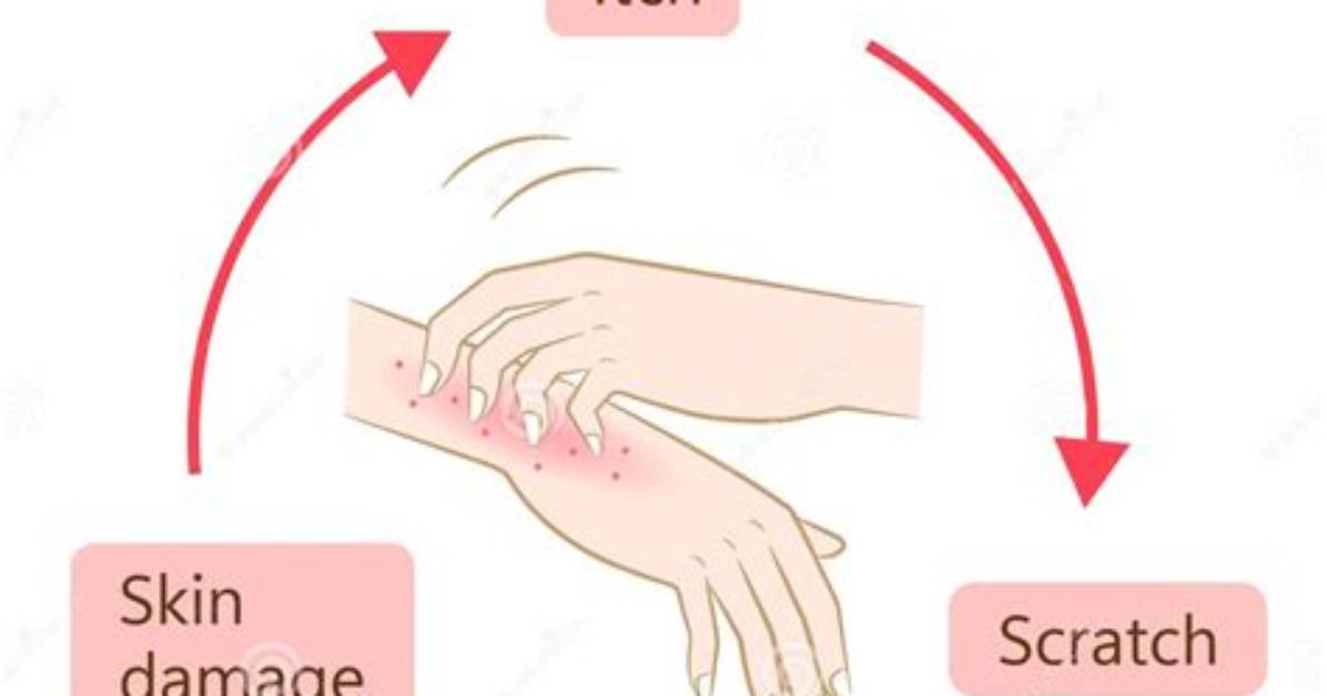 Why Do Scrapes Itch?