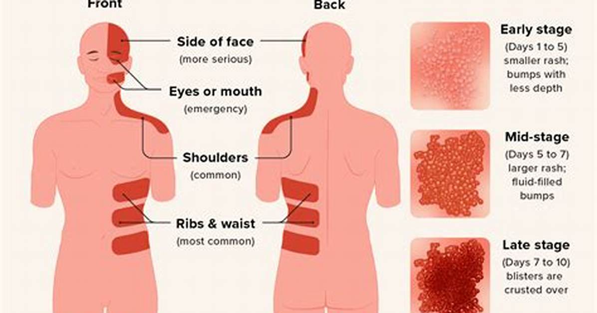Why Do Shingles Itch?