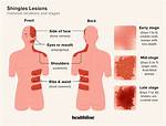Why Do Shingles Itch?