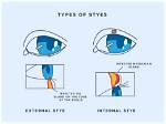 Why Do Styes Form?