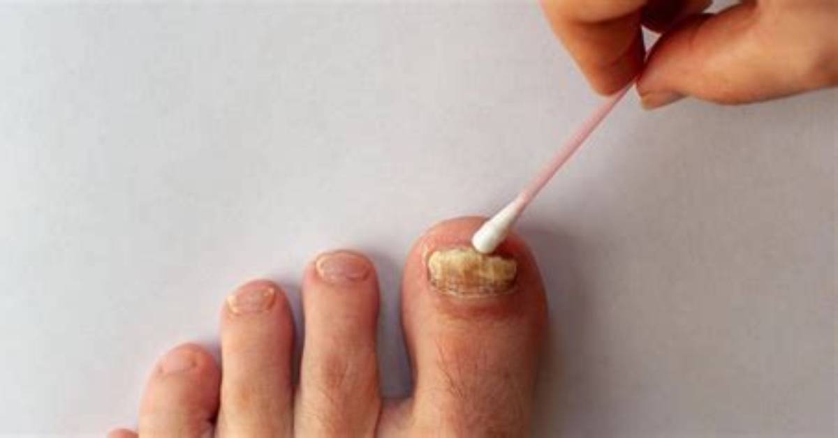 Why Do Toenails Randomly Fall off?