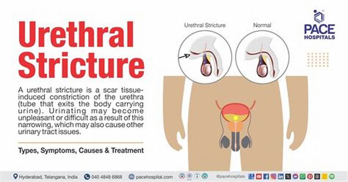 Why Do Urethral Strictures Return?