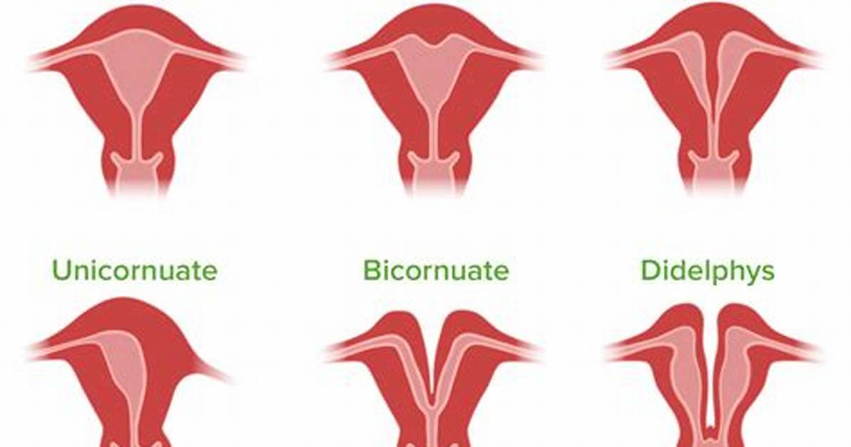 Why Do Uteruses Fall out?
