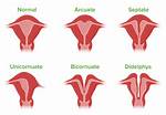 Why Do Uteruses Fall out?