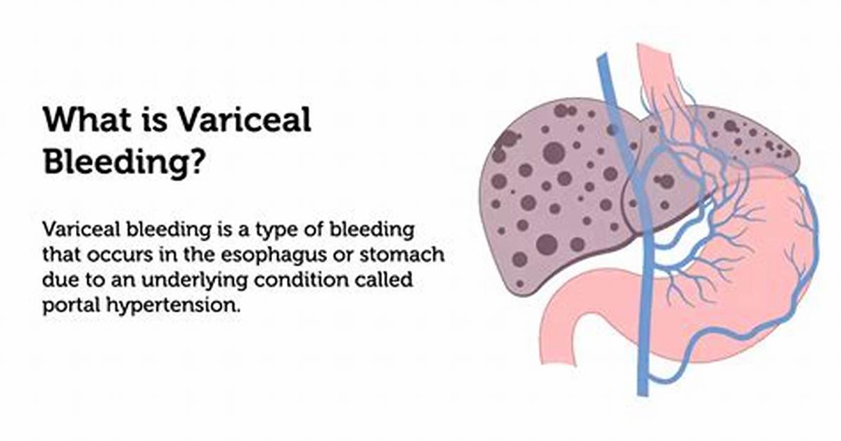 Why Do Varices Bleed?
