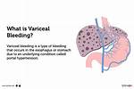 Why Do Varices Bleed?