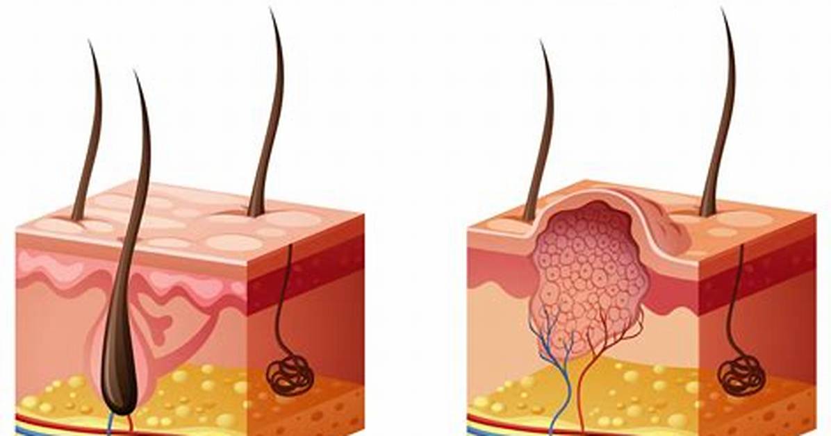 Why Do We Get Warts?