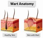 Why Do We Get Warts?