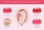Why Do You Bleed with a Subchorionic Hemorrhage?