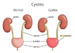 Why Do You Get Cystitis