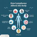 Why Do You Get Lymphomas?