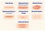Why Do You Get Scars?