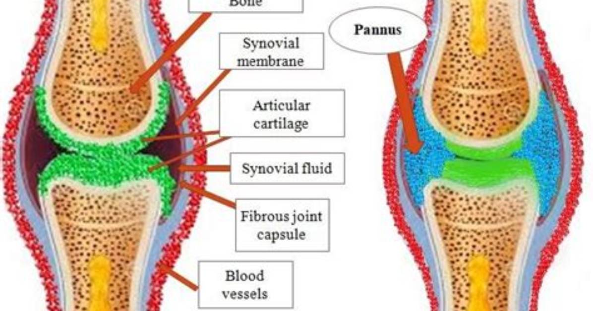 Why Does a Pannus Develop?
