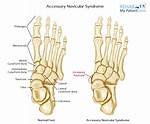 Why Does Accessory Navicular Hurt?