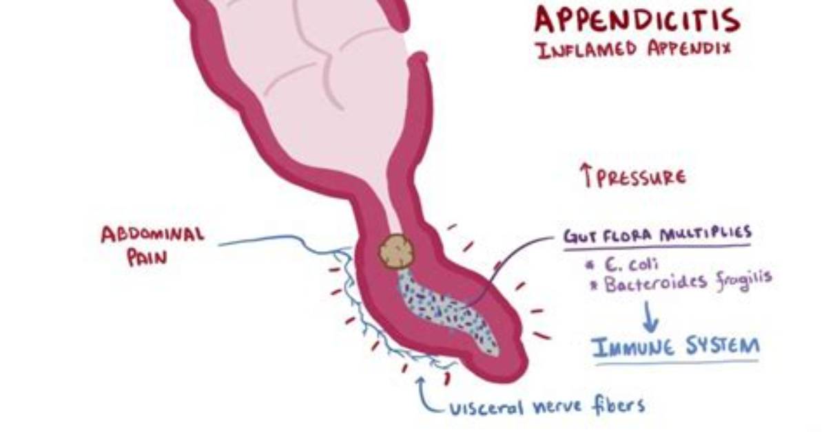 Why Does Appendix Burst?