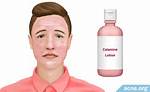 Why Does Calamine Lotion Work?