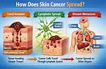 Why Does Cancer Spread?