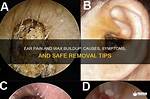 Why Does Cerumen Itch?