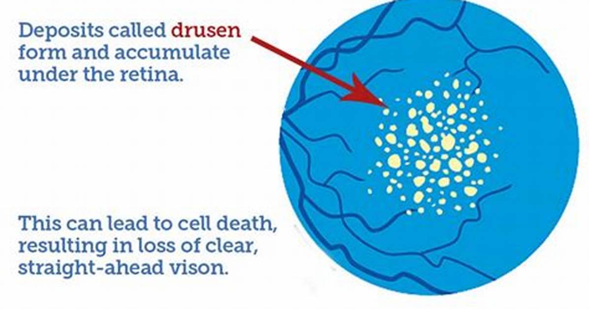 Why Does Drusen Occur?