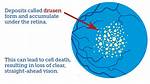Why Does Drusen Occur?