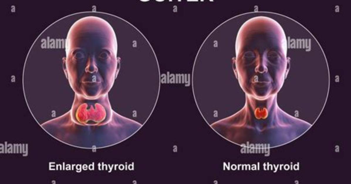 Why Does Goitre Occur?